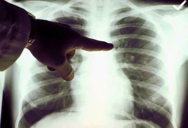 医疗影像中观察出的“肺结节”是诊断肺癌的重要依据